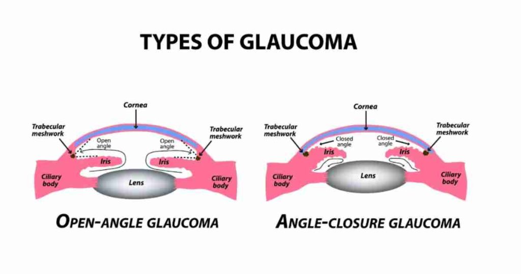 Glaucoma