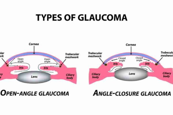 Glaucoma